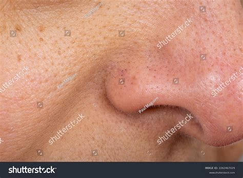 Blocked Enlarged Pores Close Nose Face Stock Photo 2262467029 | Shutterstock