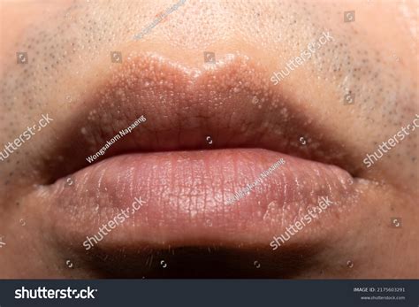 Small Bumps On Lips