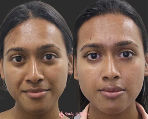 Botox Frown Lines Before And After