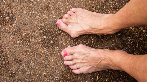 Hammertoe Surgery Recovery Time: How Long Does It Take?