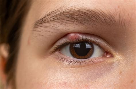 Is Blepharitis Contagious? | Sage Eyecare | Toronto