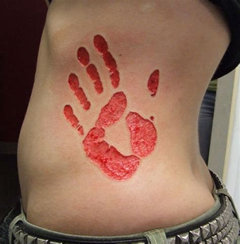 Tattoo Keloid Scar Treatment at Eva Howse blog