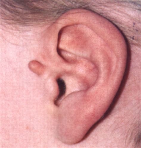 Sebaceous Cyst Ear at Maureen Baker blog