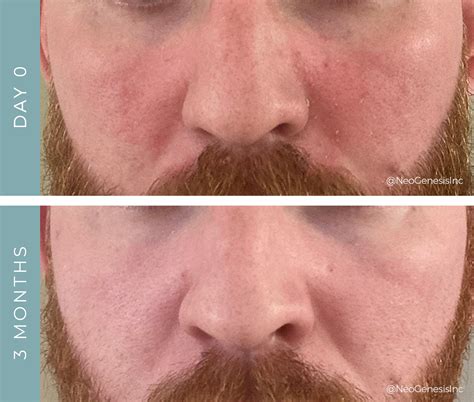 Seborrheic Eczema Face