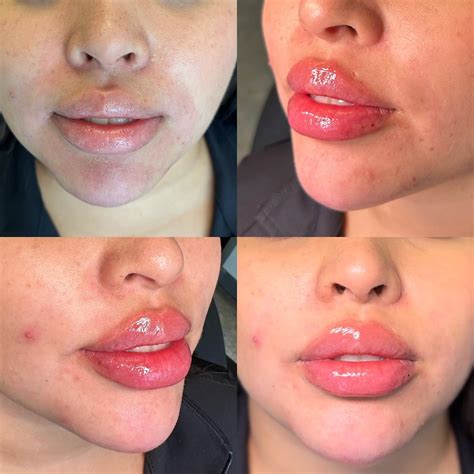 Patient 146737646 | Lip Fillers Before & After Photos | Dr. Courtney Plastic Surgery