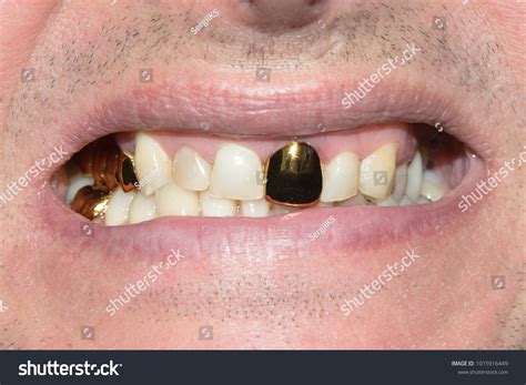 Gold Teeth Austin Texas at Victoria Jenkins blog