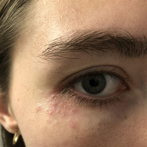 Small red bumps under eye (3 weeks) : r/DermatologyQuestions