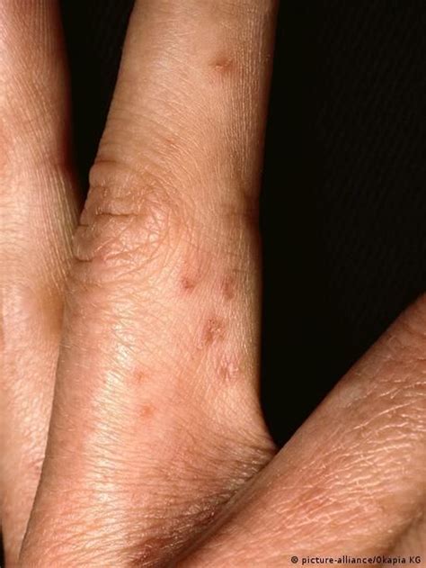 La sarna: consejos para prevenir y tratar esta enfermedad