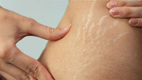 8 Proven Tips to Permanently Remove Stretch Marks