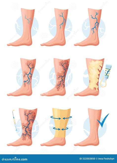 Stages or Types of Varicose Veins Development. Medical Poster or ...