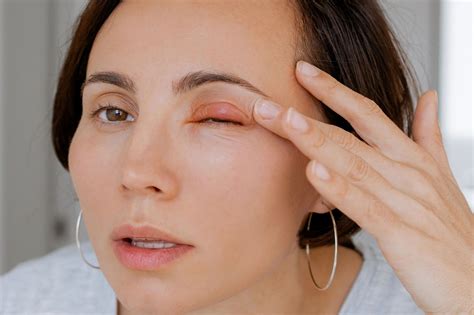 Midwest - Irritated eyelids? It could be Demodex blepharitis! A new ...