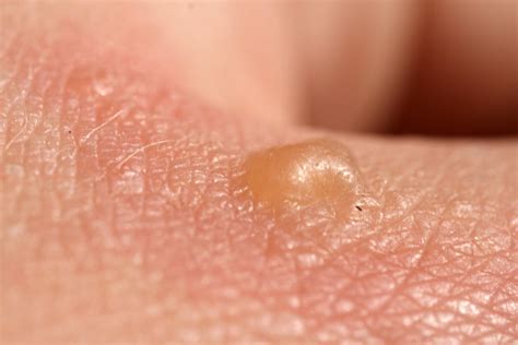 Skin Rash Small Fluid Filled Blisters at Aaron Kissel blog