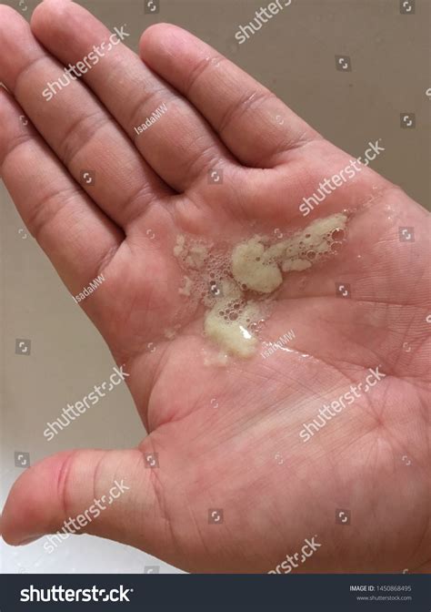 Coughing Up Green Phlegm