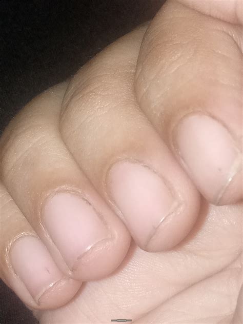 Ask a Dermatologist Online for Black Dots On Nails Like Blood