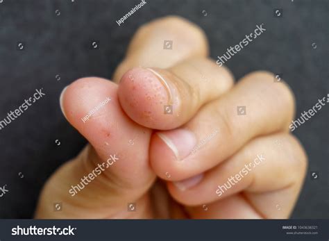 Dyshidrotic Eczema Fingers
