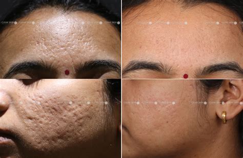 Acne Scars Before And After Laser Laser Treatment For Acne Scars