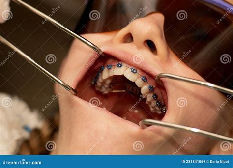 Metal Mouth Braces