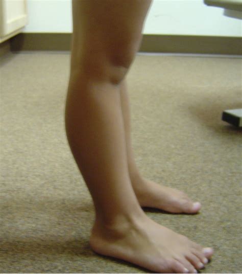 Hip Knee Hyperextension