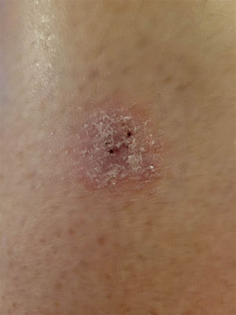 f30: spot on leg won't go away. : r/DermatologyQuestions