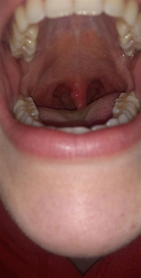 Pimple Like Bump On Uvula