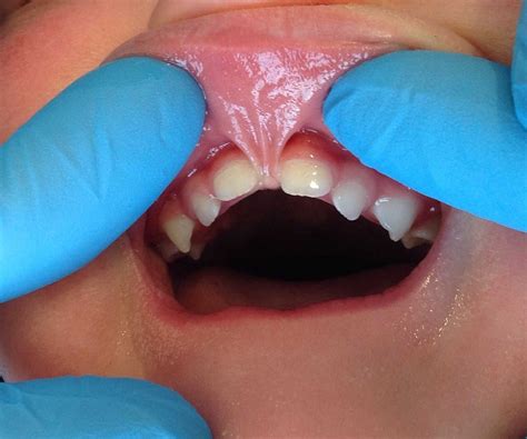List 102+ Pictures Tongue-tie Pictures Newborn Sharp