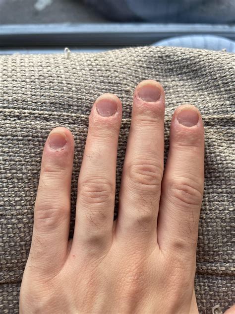 Small fluid filled bumps on fingers, extremely itchy : r/DermatologyQuestions