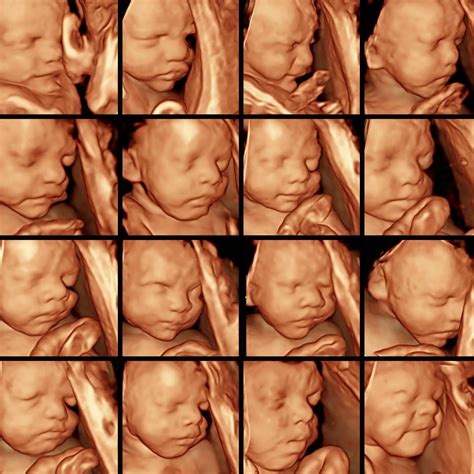 3d Ultrasound 30 Weeks Twins