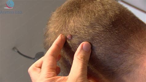 Moles On Scalp