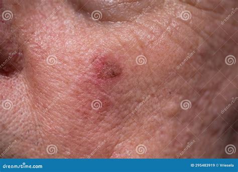 Actinic Keratosis or Sunspots on Sun-damaged Skin Stock Image - Image of cheek, bumps: 295483919