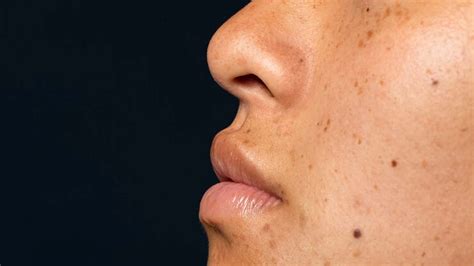What Causes Black Spots on Face? – NutritionFact.in