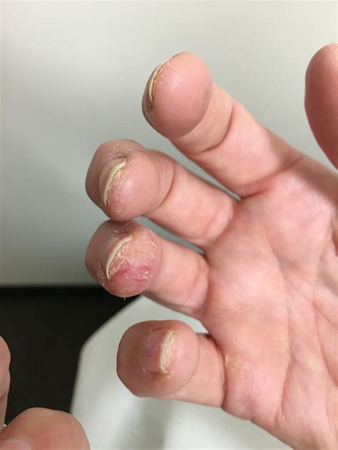 Nail Tech Contact Dermatitis at Victor Fox blog