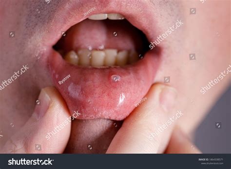 21 Mucocele lip: immagini, foto stock e grafica vettoriale | Shutterstock