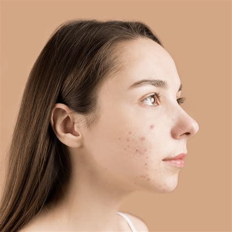 Acne Scars 101: Effective Tips to Reduce Pimple Marks