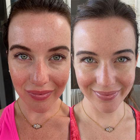 32 f. I just completed one month of using red light therapy. I used this mask consistently 5-7x ...