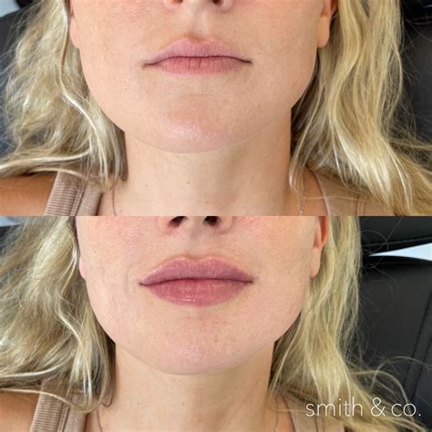 Botox lip flip – Artofit