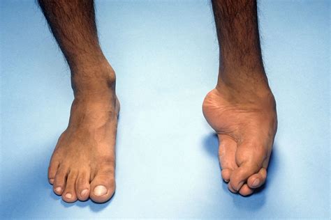 Cleft Foot