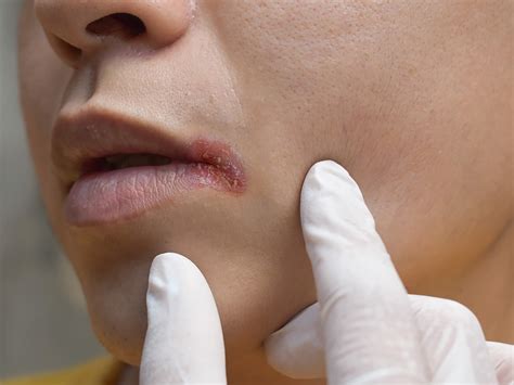 How To Prevent And Treat Angular Cheilitis - Crosby Family Dental