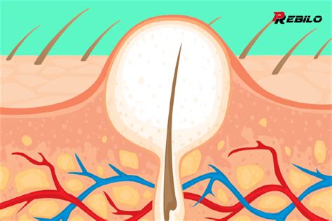 10 ways to prevent and treat ingrown hairs like a pro