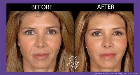 Fat Injections In Face Surgery Online | varsana.com
