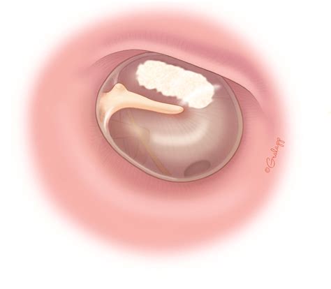 Bulging Eardrum Diseases Of The Ear: ATLAS OF DISEASES OF THE EAR