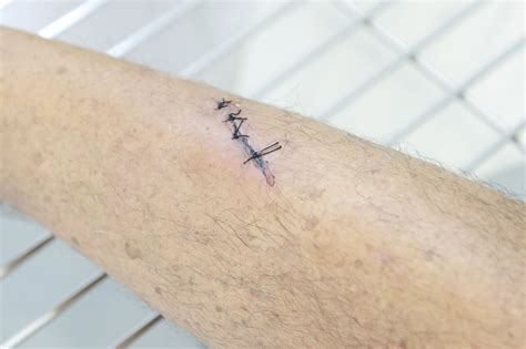 Do Urgent Care Do Stitches - How To Know If A Cut Requires Stitches ...