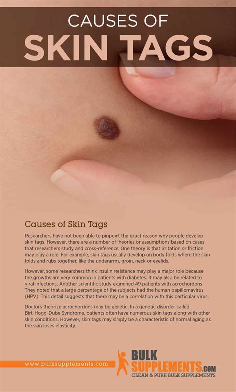 Skin Tag Neck