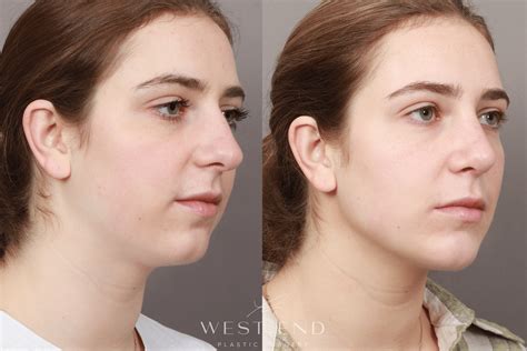 Jaw Implants Before And After