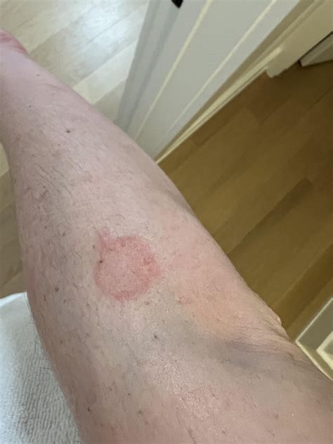 Pityriasis Rosea or Ringworm? : r/DermatologyQuestions