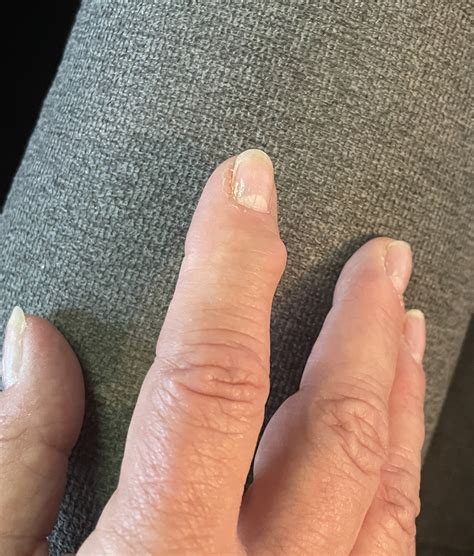 Bump On Finger