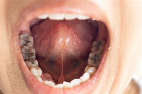 Why Do My Fillings Hurt? - Online Dental Care