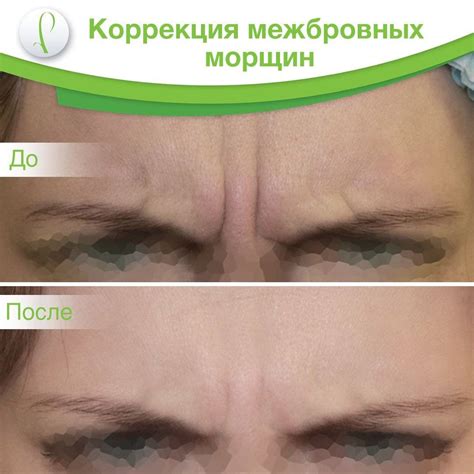 Межбровная морщина: как убрать и избавиться от складок и заломов на лбу ...