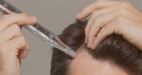 Treatments – Microneedling Hair Growth - Laser Loft