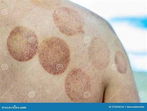 Circular Bruises on a Back and Shoulder after Cupping Therapy Stock Photo - Image of adult ...