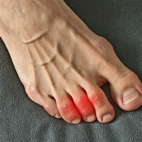 Gout - Signs, Symptoms, Treatment in Women and Men in Dubai